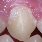 Notare il materiale bianco tra dente e gengiva (placca)