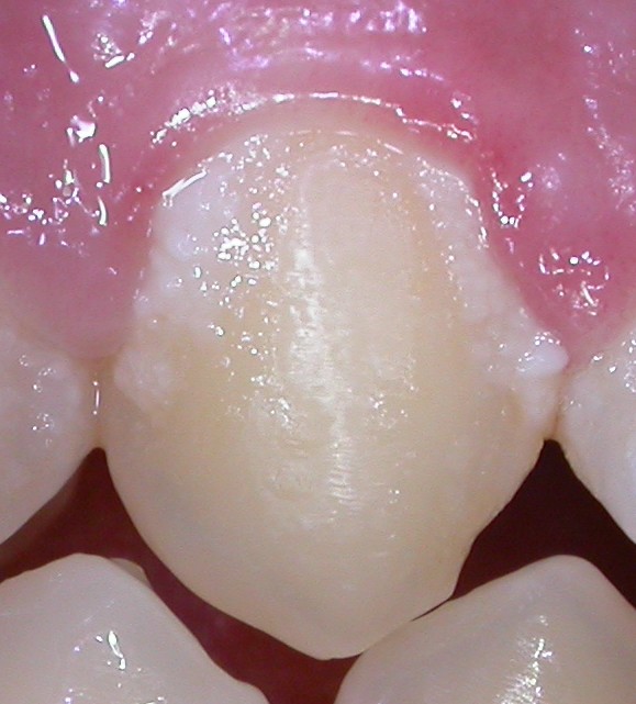 Gengivite iniziale2