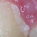 Particolare della placca e gengiva infiammata