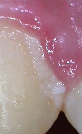 Gengivite iniziale3