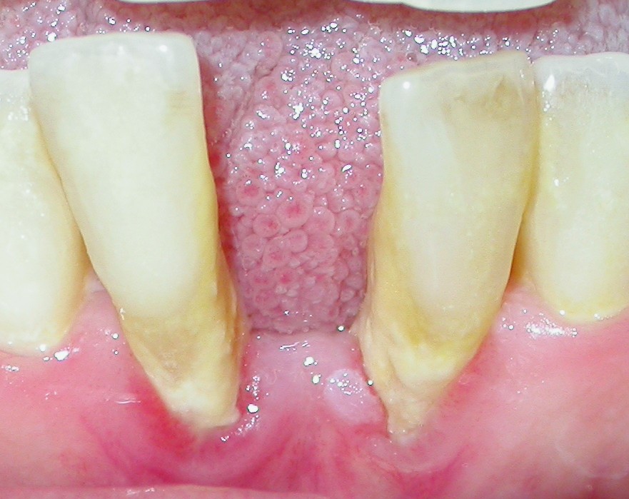 Gengivite marginale